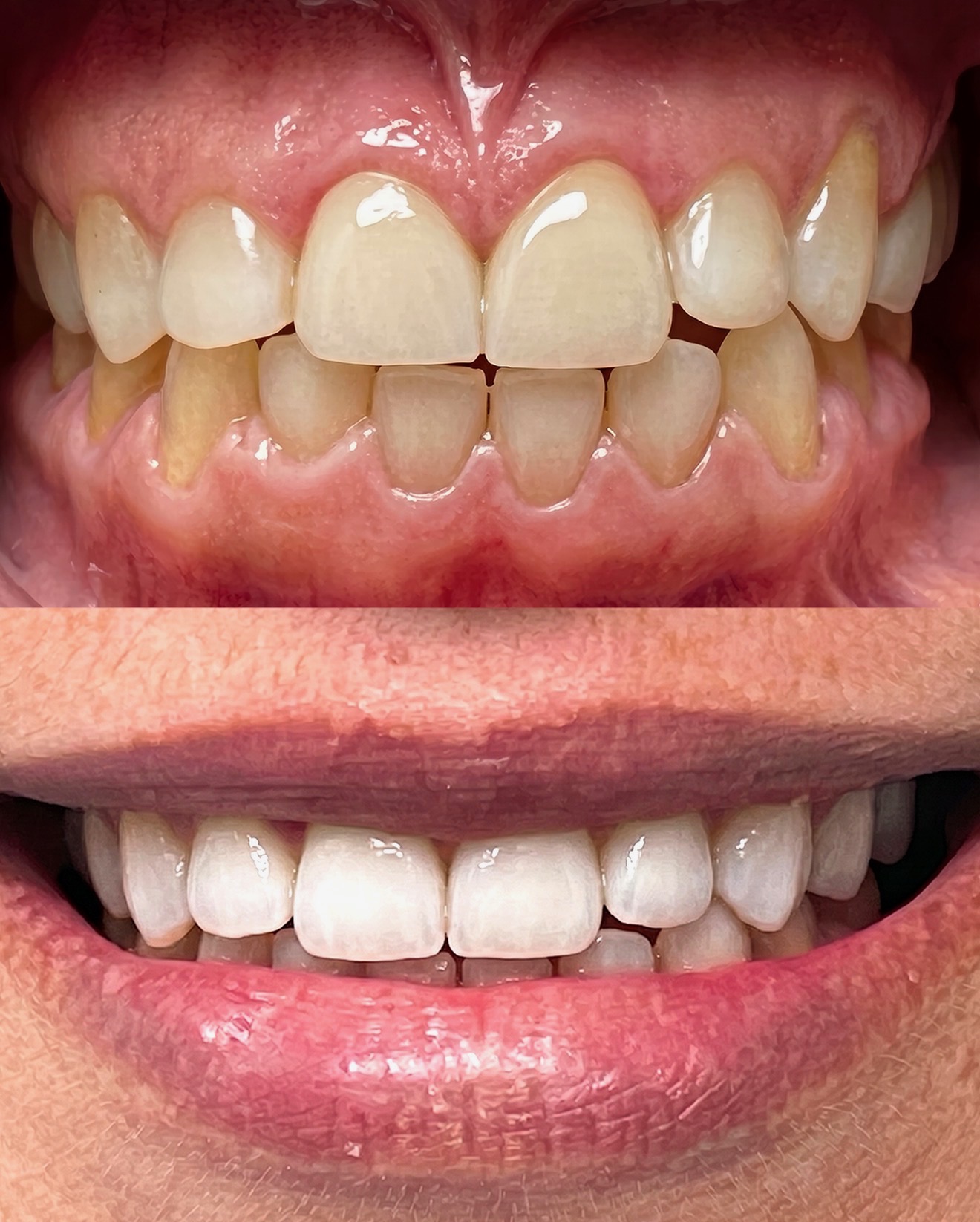 Whitening & Alignment — before and after at Palm Springs Dental