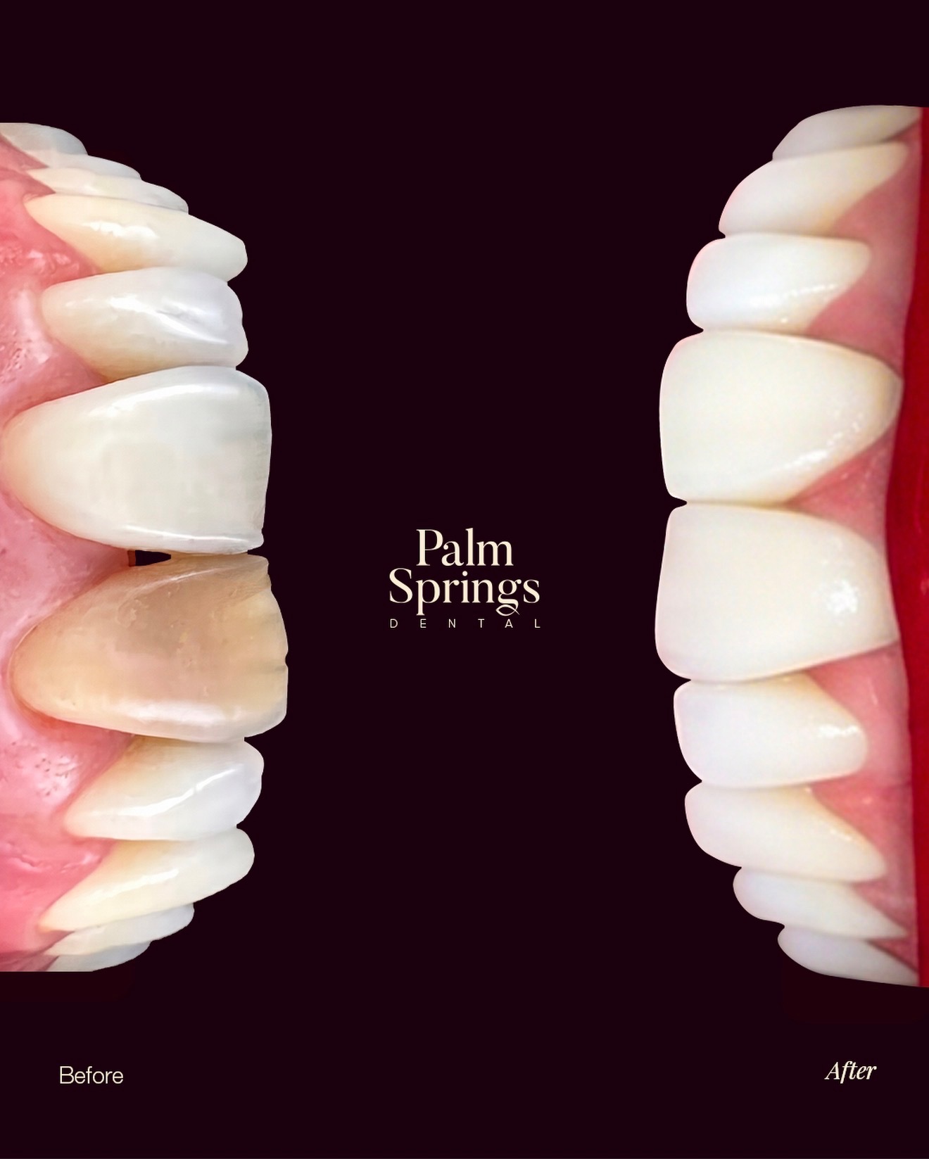 Cosmetic Restoration — before and after at Palm Springs Dental