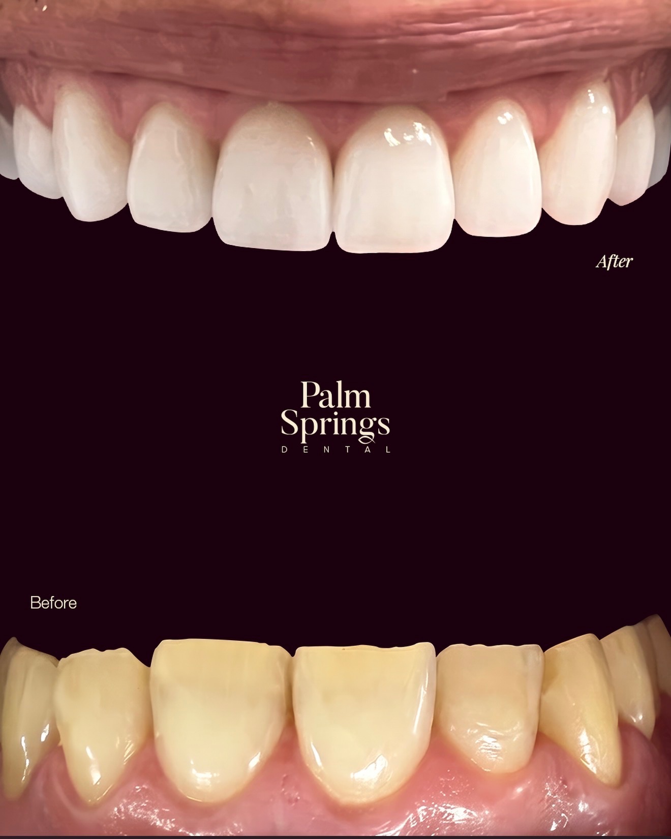 Smile Makeover — before and after at Palm Springs Dental