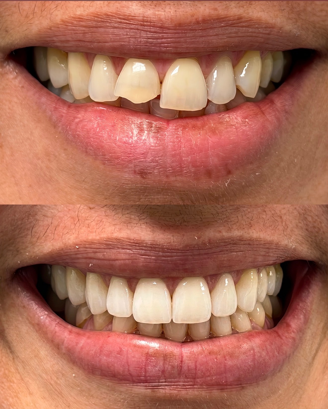 Bonding & Whitening — before and after at Palm Springs Dental