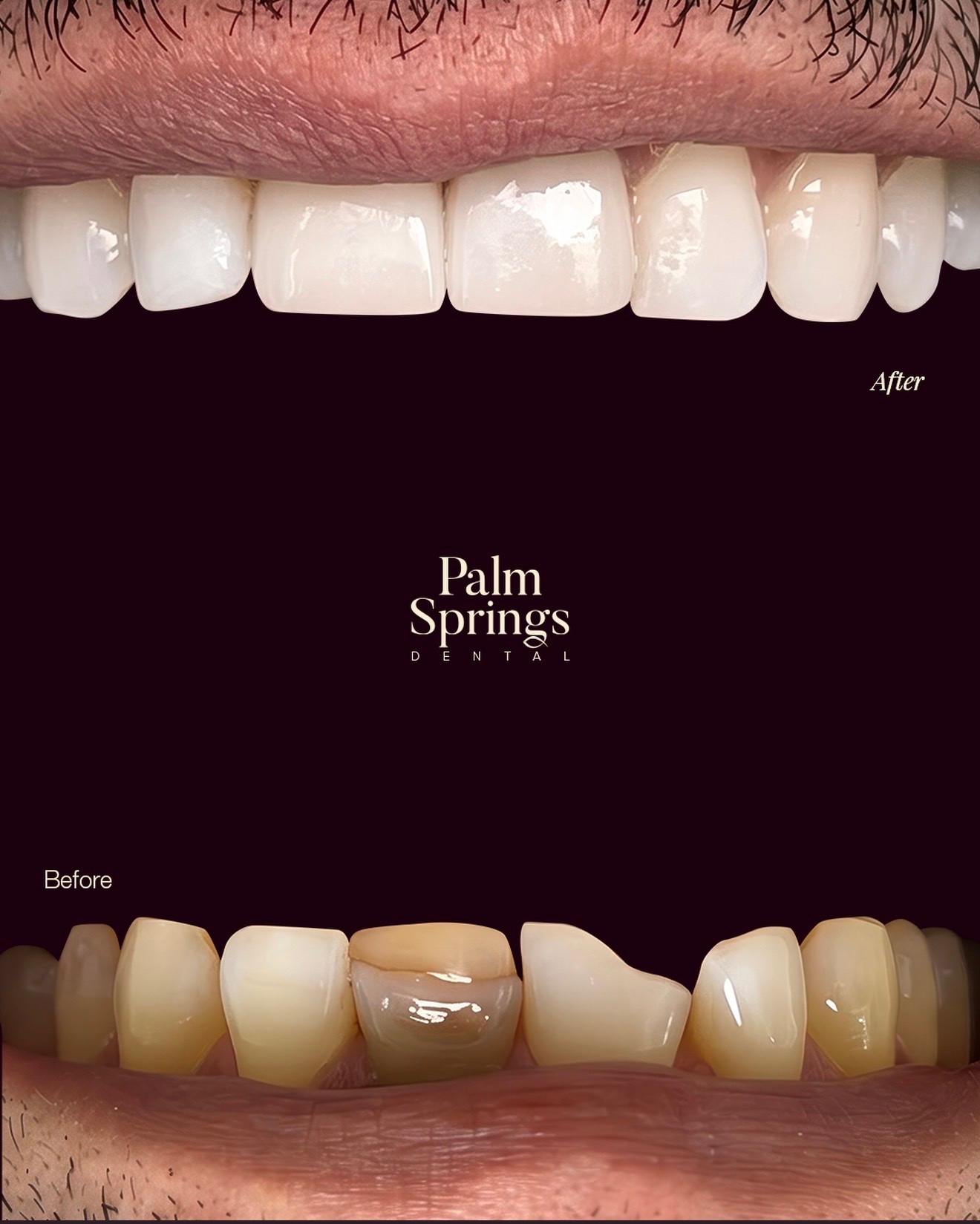 Porcelain Veneers — before and after at Palm Springs Dental