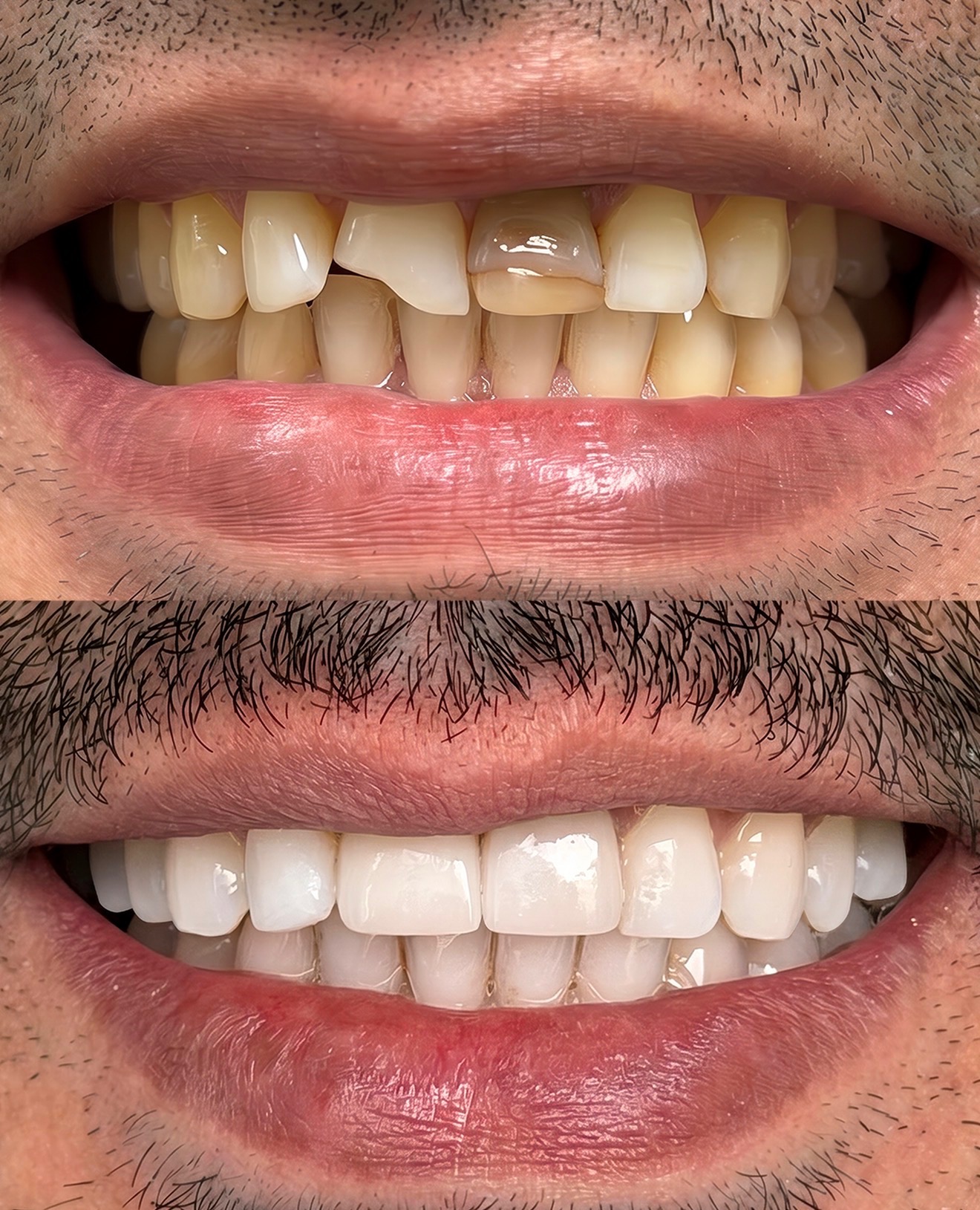 Full Smile Transformation — before and after at Palm Springs Dental