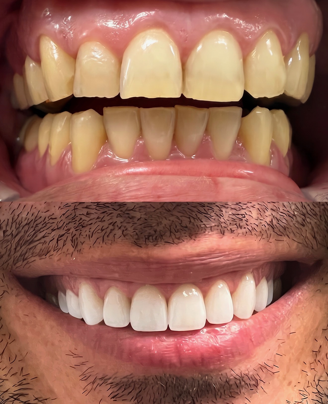 Complete Reconstruction — before and after at Palm Springs Dental